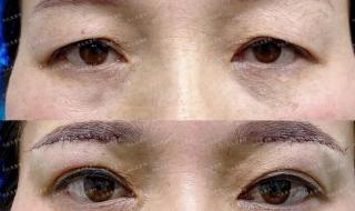 筋膜悬吊和筋膜提升一样吗 筋膜悬吊和筋膜提升一样吗